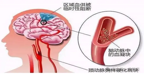 卒中心梗早发现，步长青花瓷脑心通脑心同治，防治兼备