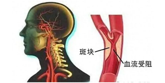 “定时炸弹”颈动脉斑块,中医药全方位帮你消除